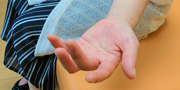 腱鞘炎・ばね指の等尺性治療